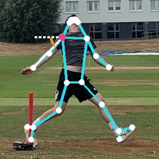Delayed arm measured at FFC, angle drawn on the frame